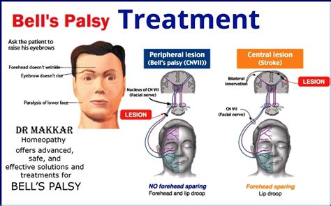 bell's palsy vs stroke innervation